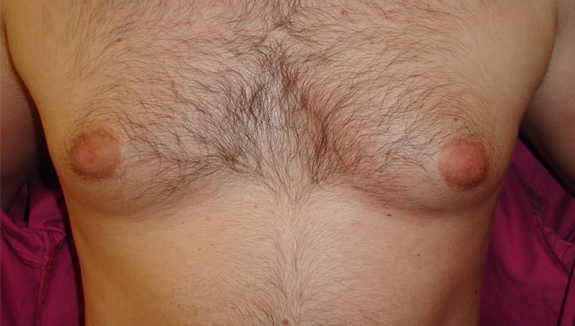 Gynecomastia - after 6 months